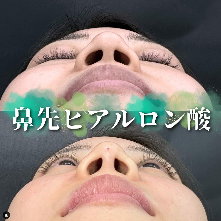 玻尿酸填充