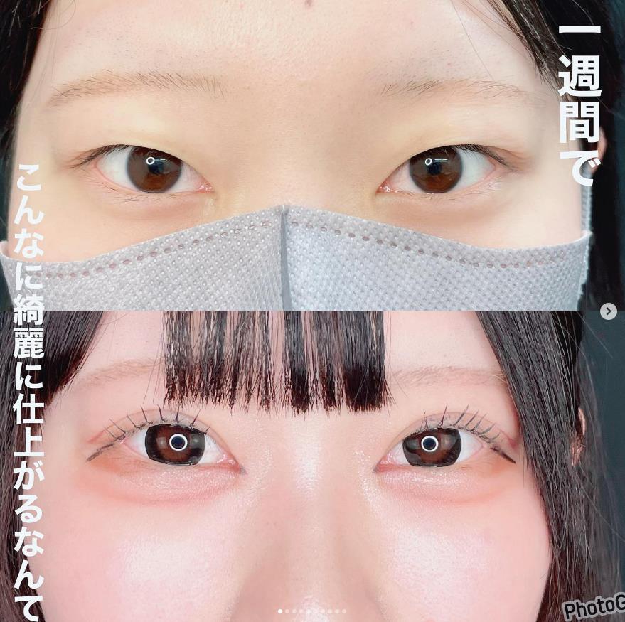 双眼皮手术