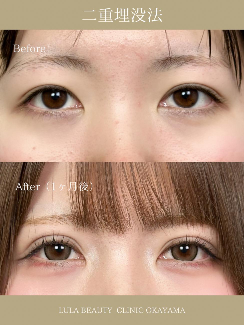 双眼皮手术
