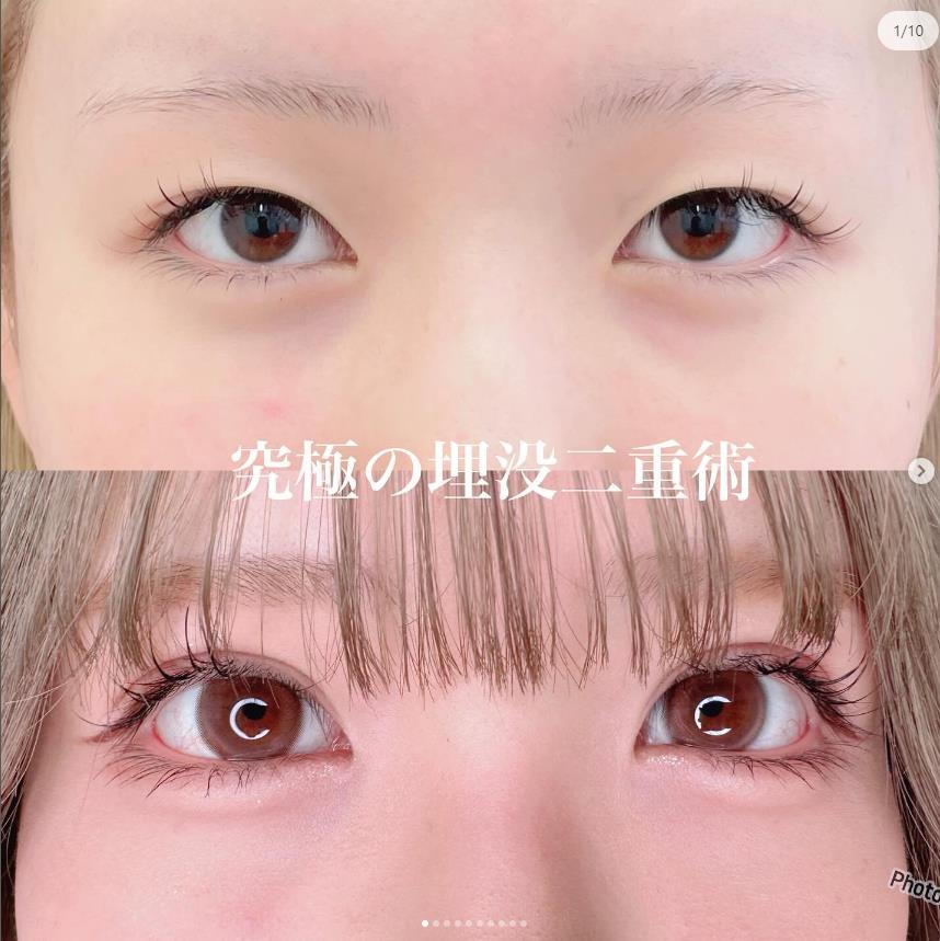 双眼皮手术