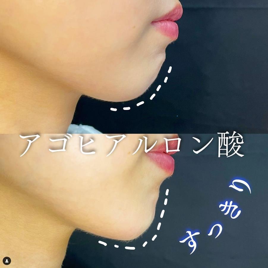 玻尿酸填充