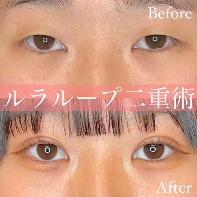 双眼皮手术