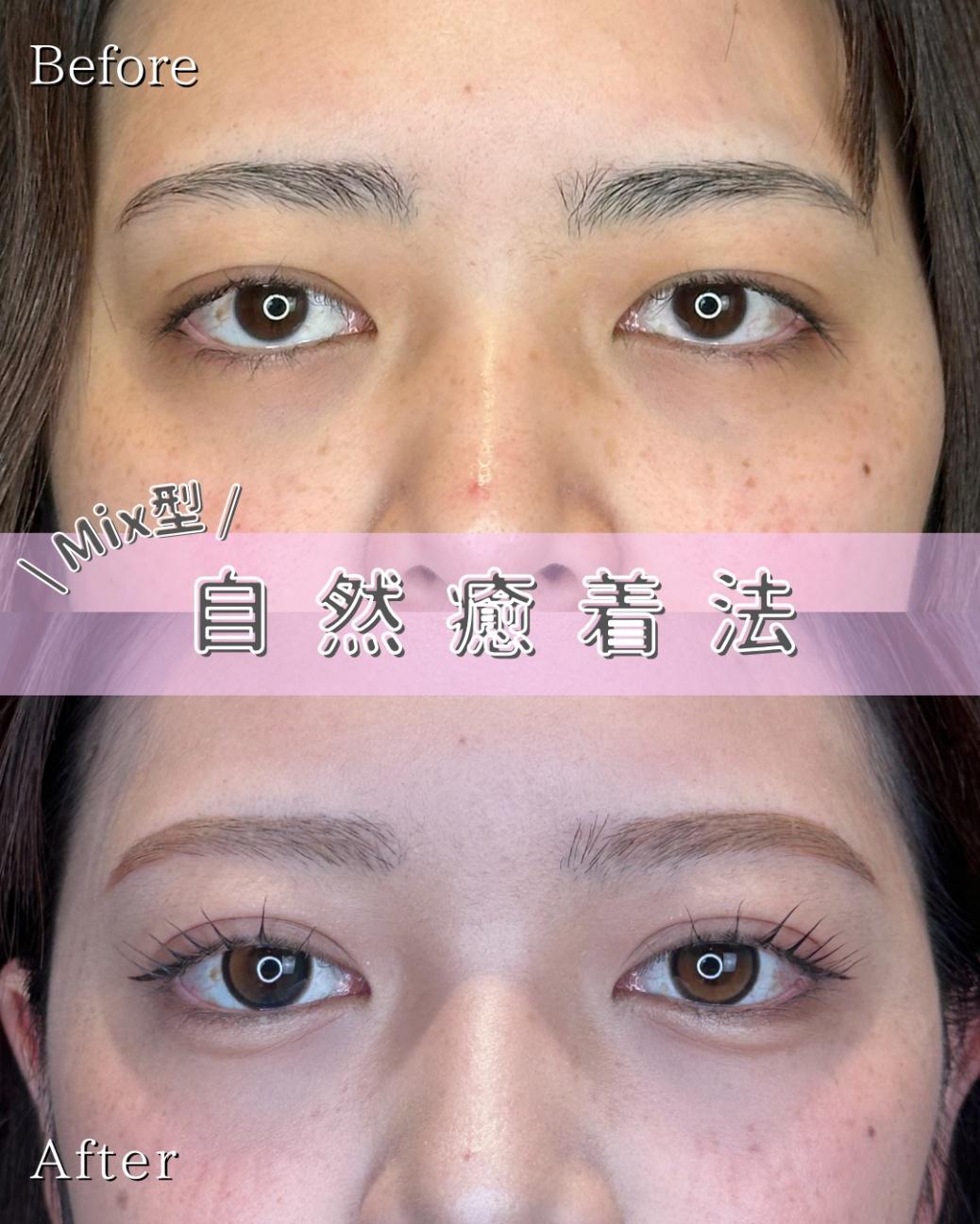 双眼皮手术