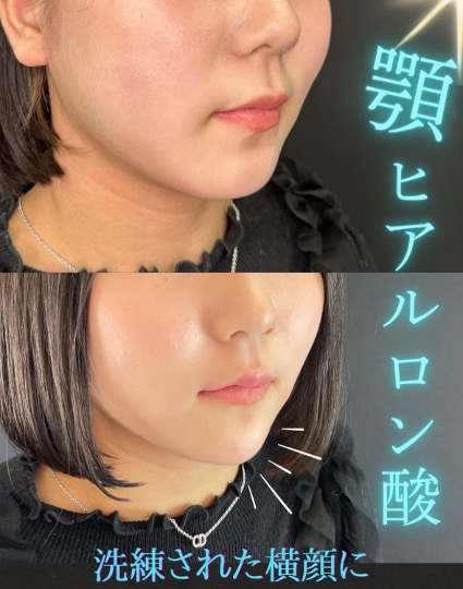 玻尿酸填充