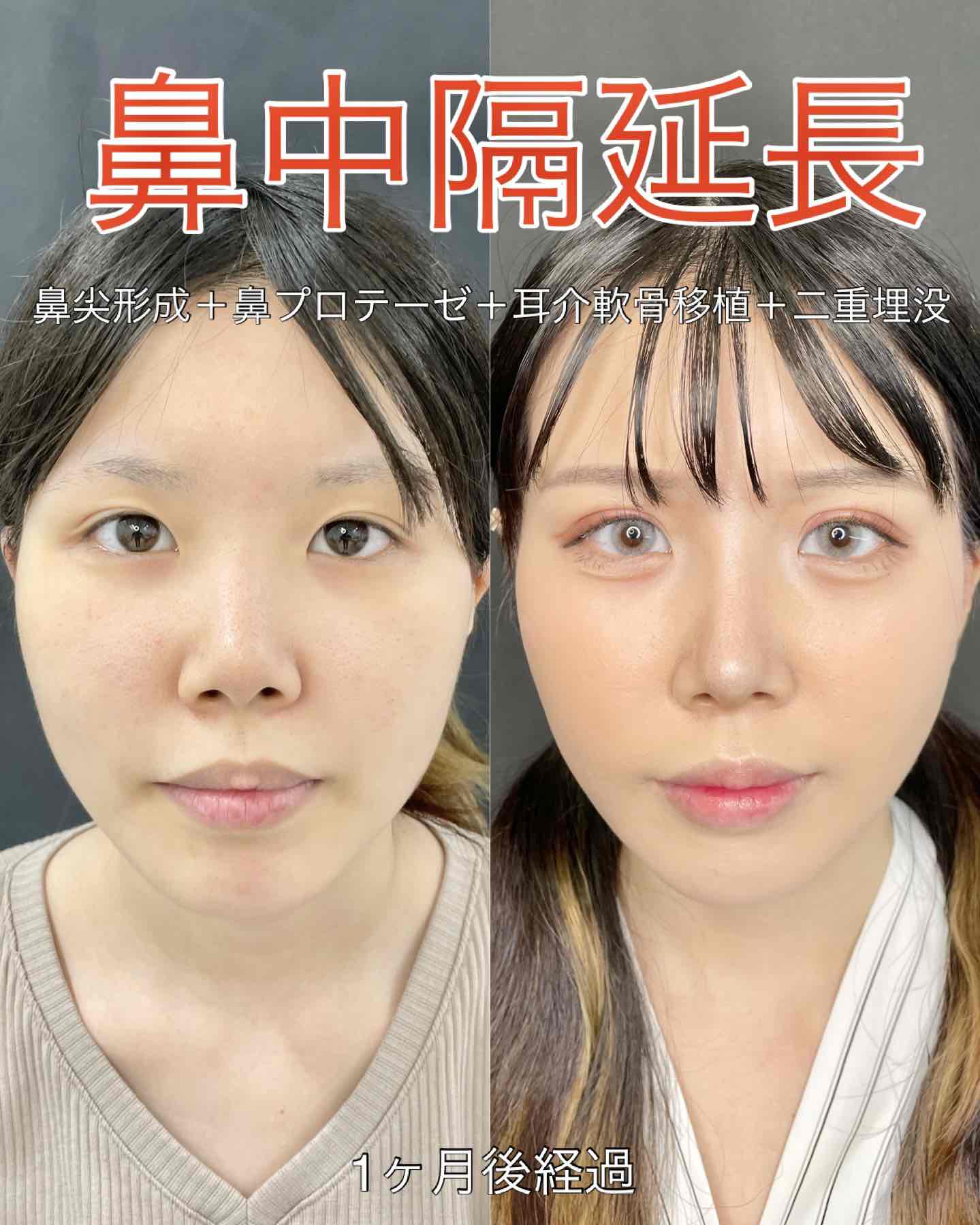 鼻综合整形 + 鼻尖整形 - 鼻中隔延长术