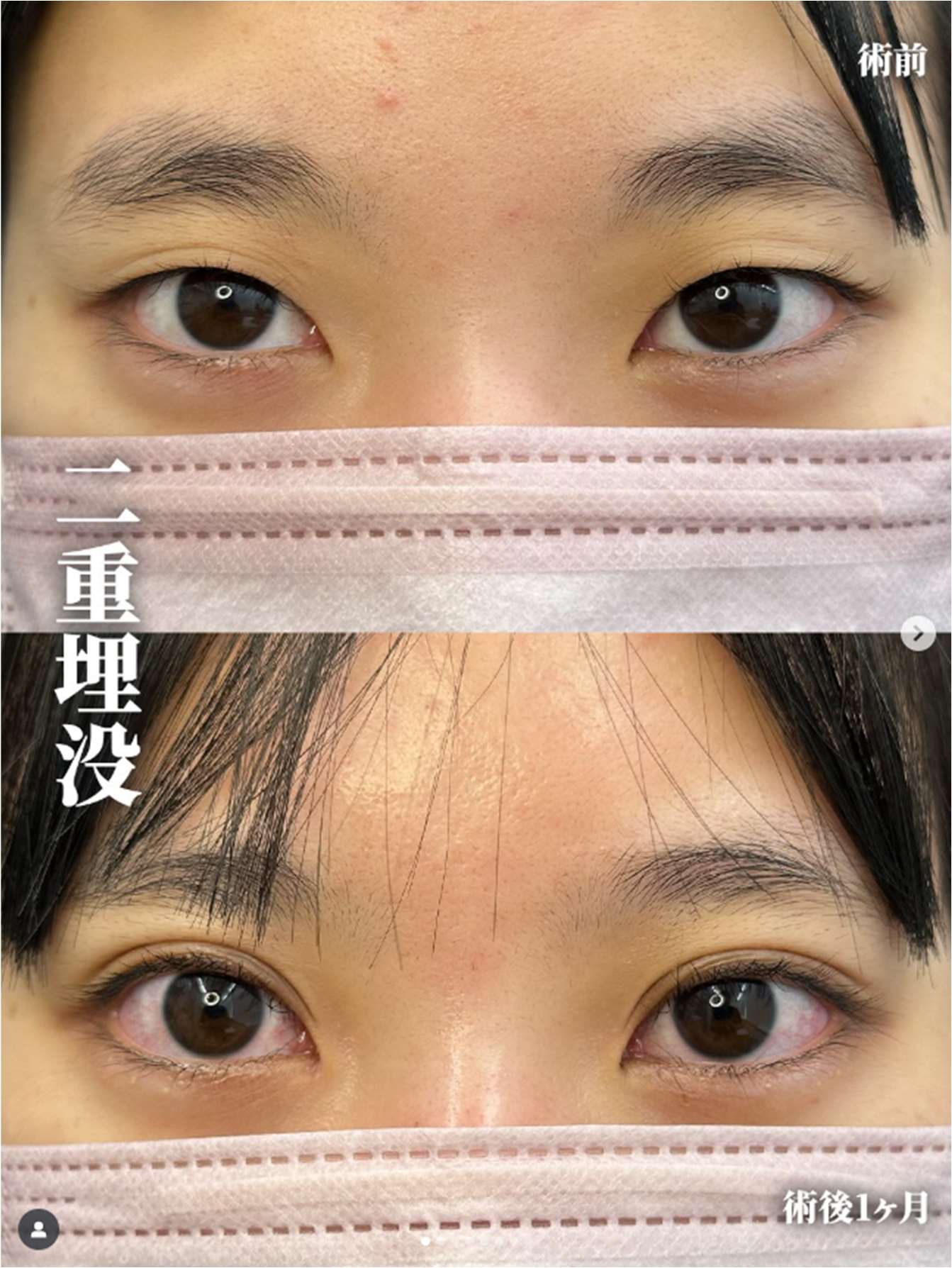 双眼皮手术