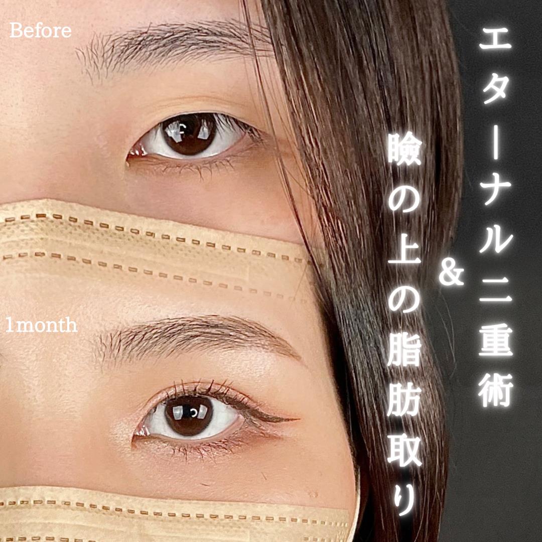 双眼皮手术