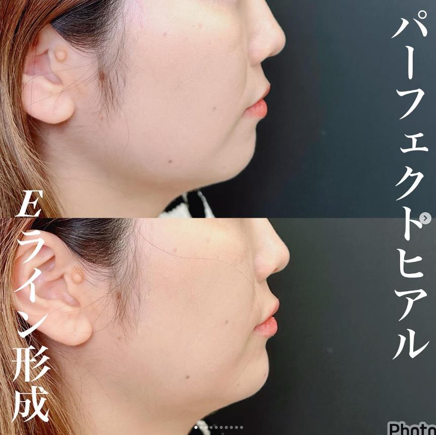 玻尿酸填充
