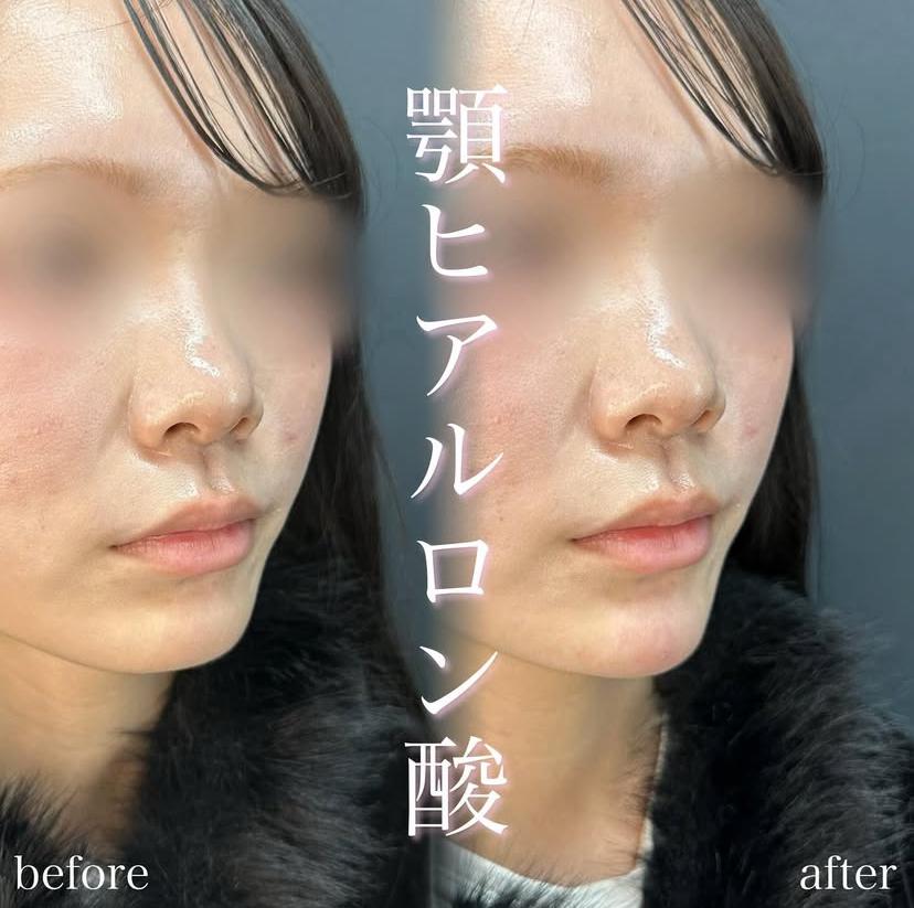 玻尿酸填充