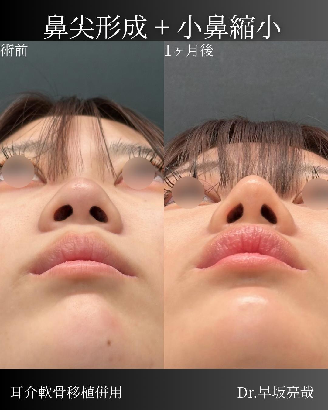 鼻综合整形 + 鼻尖整形 - 切开法