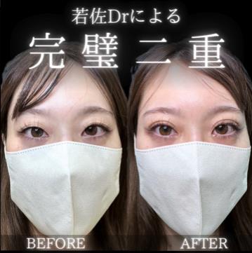 双眼皮手术