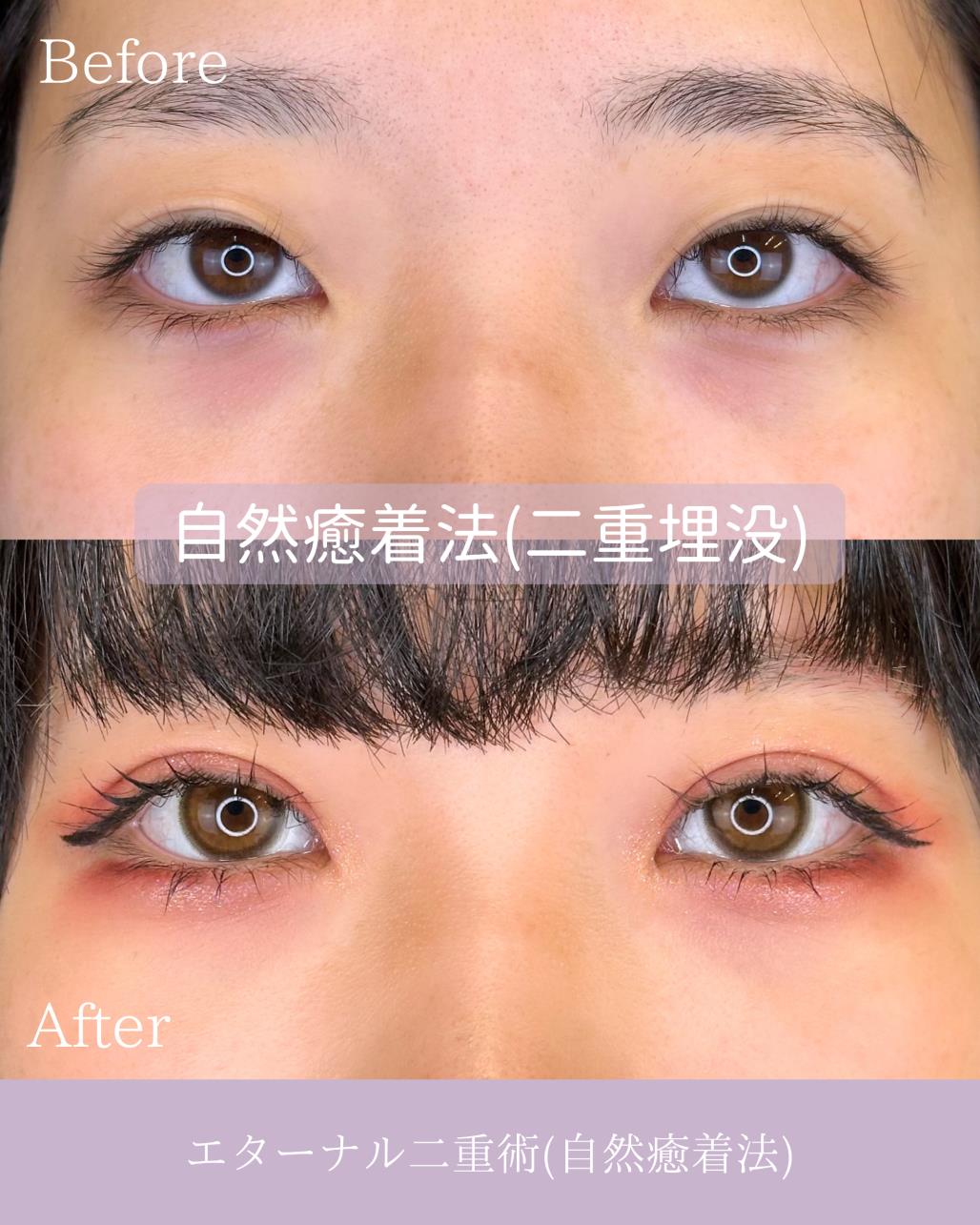 双眼皮手术