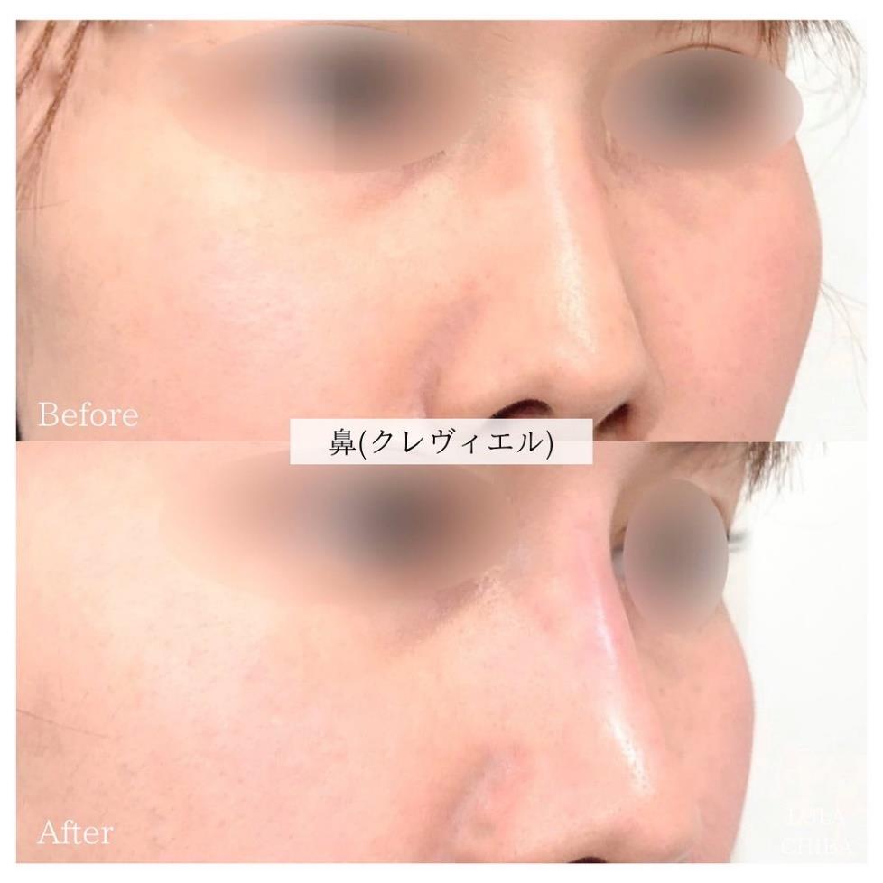 玻尿酸填充