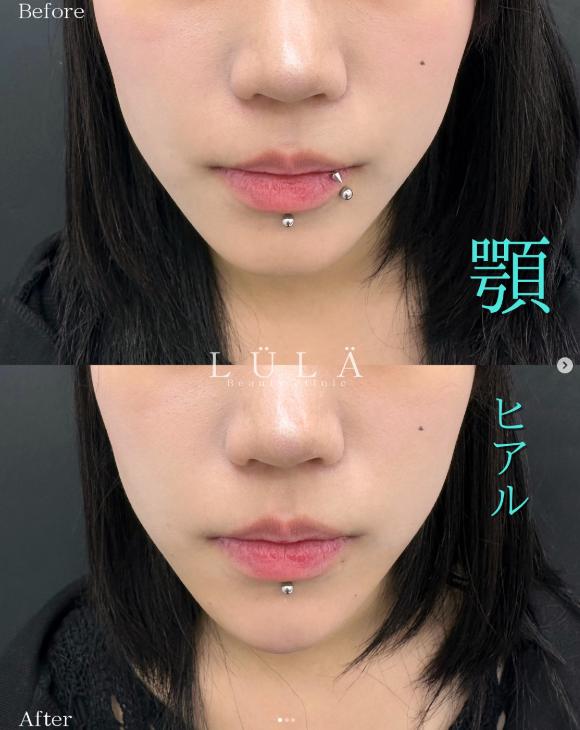 玻尿酸填充