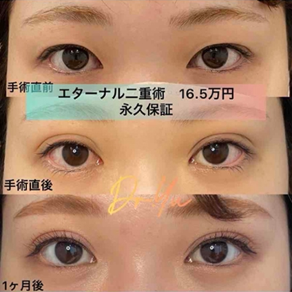 双眼皮手术