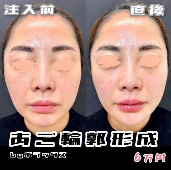 玻尿酸填充