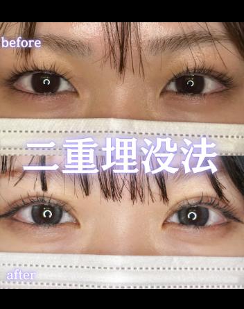 双眼皮手术