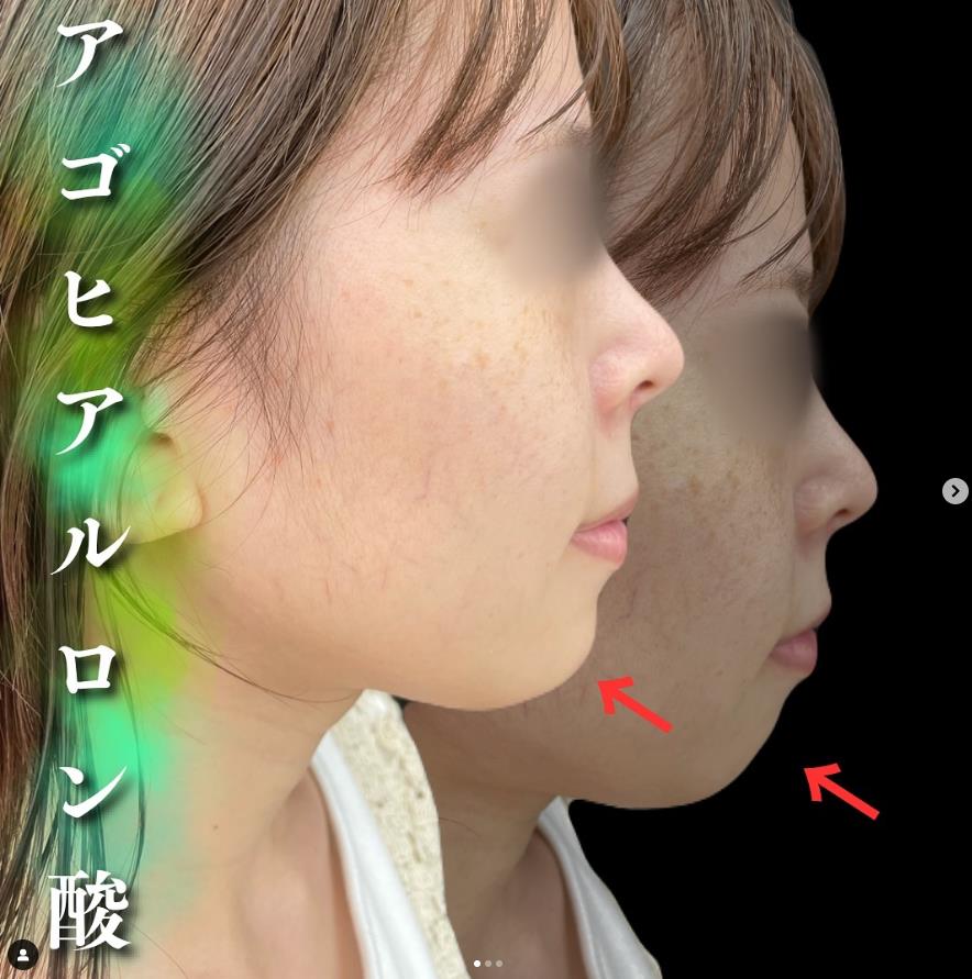 玻尿酸填充
