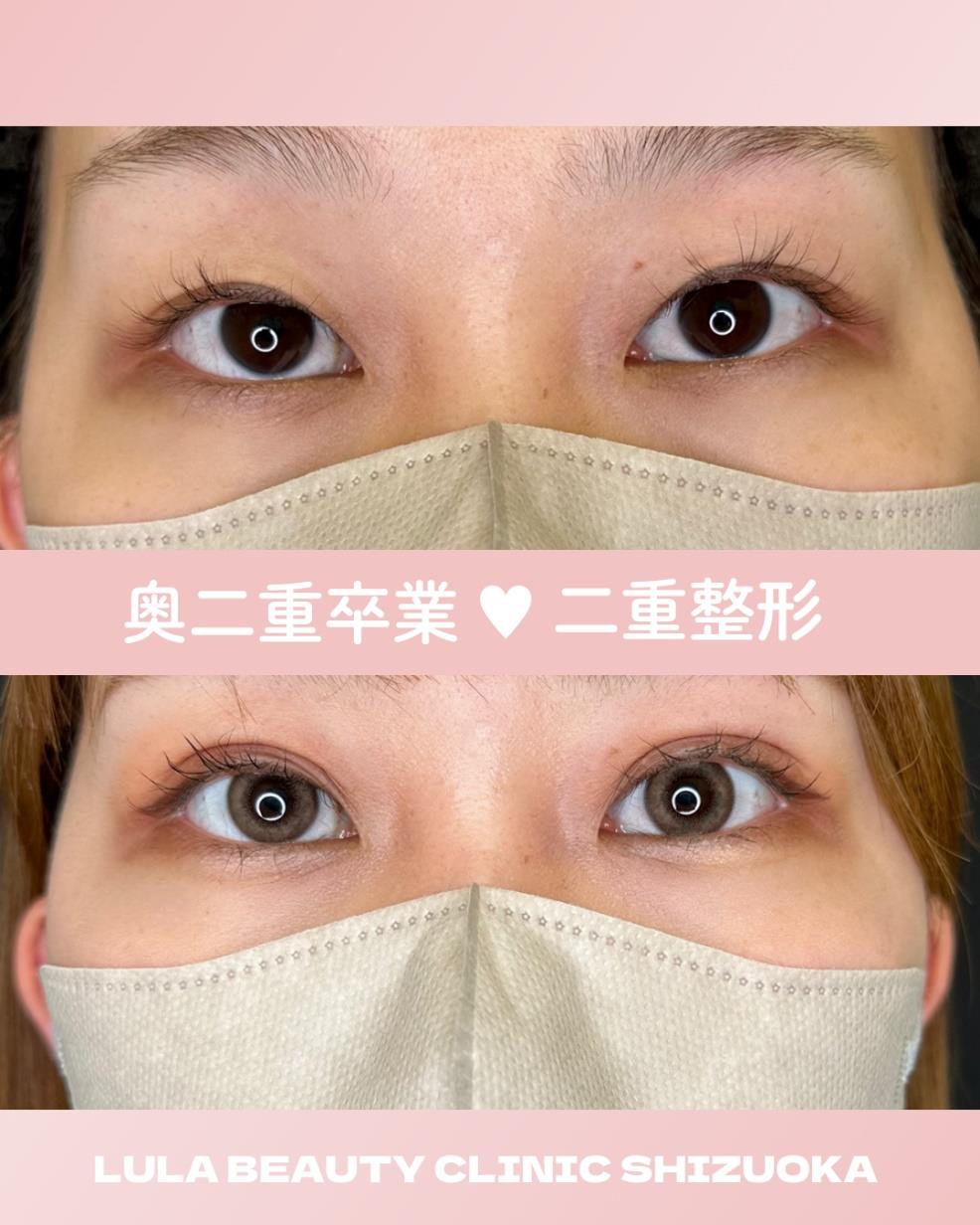 双眼皮手术