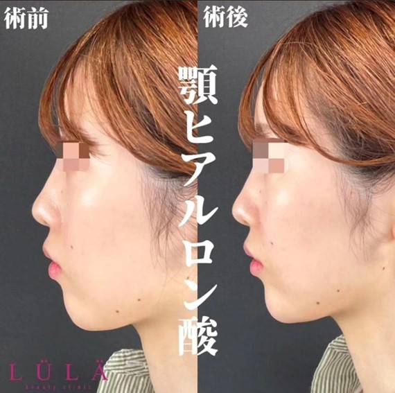 玻尿酸填充