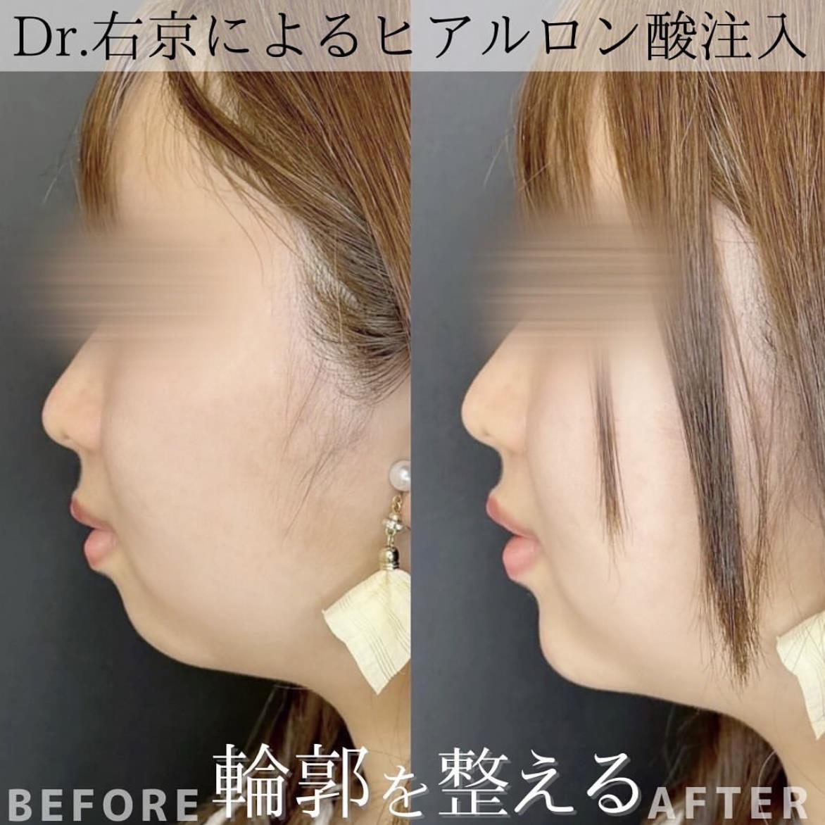 玻尿酸填充