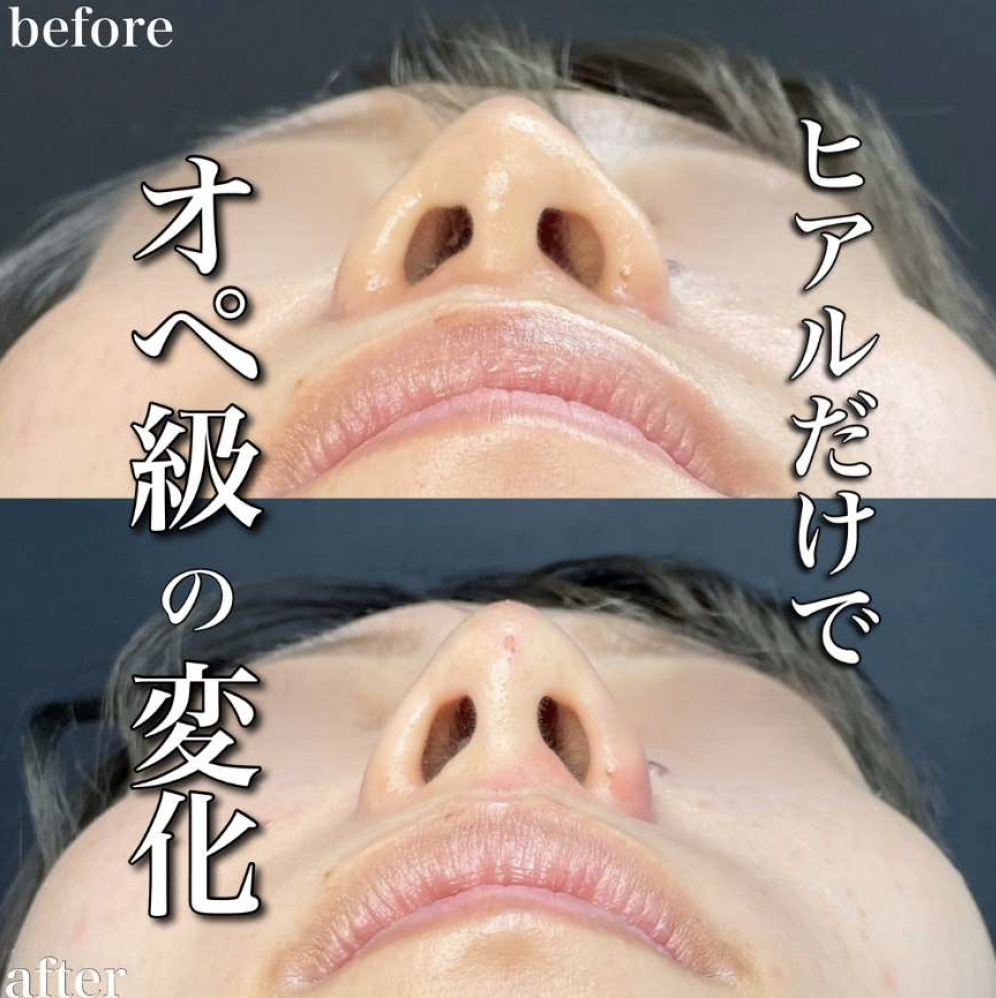 玻尿酸填充