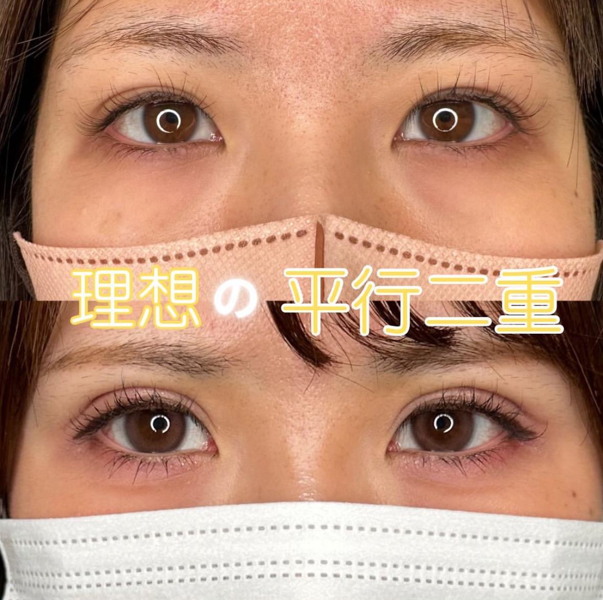 双眼皮手术