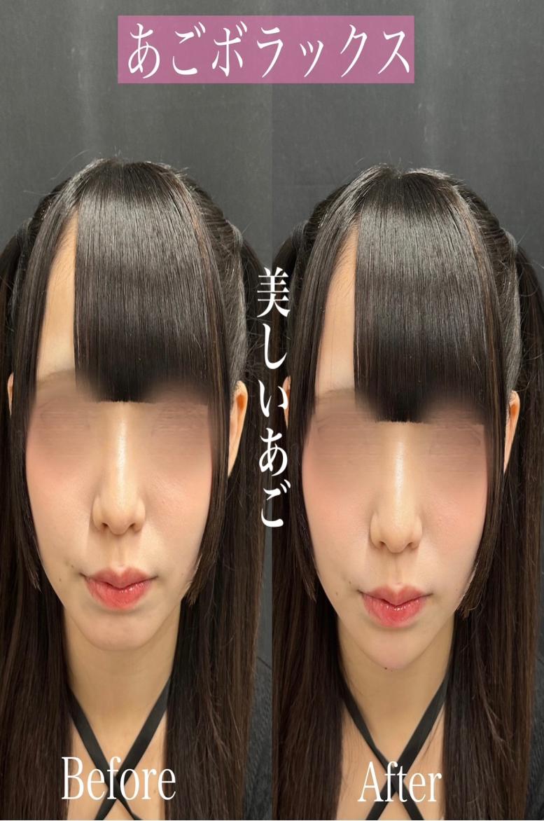 玻尿酸填充