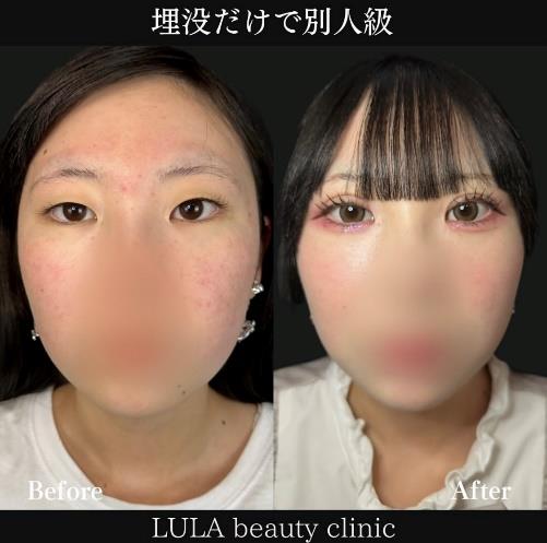 双眼皮手术