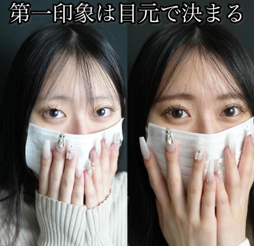 双眼皮手术