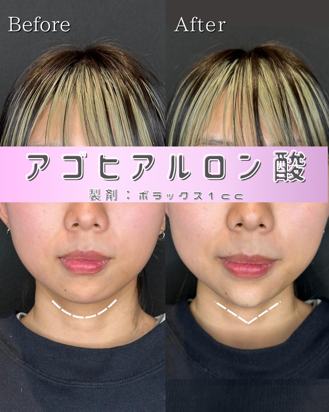 玻尿酸填充