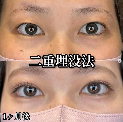 双眼皮手术