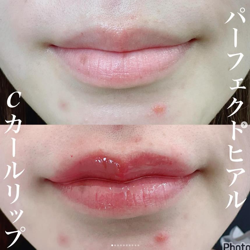 玻尿酸填充