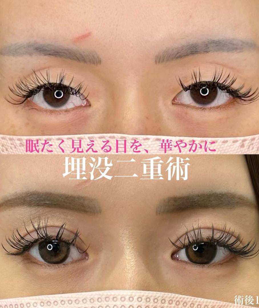 双眼皮手术