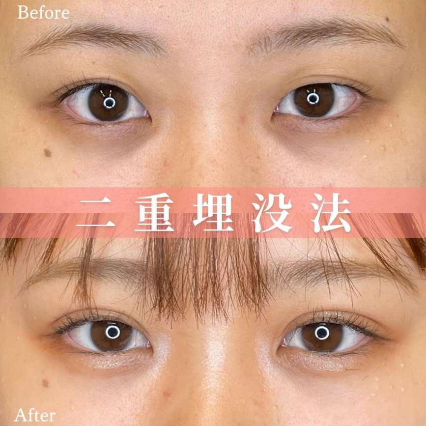 双眼皮手术