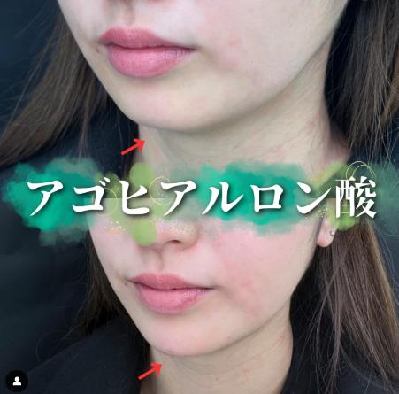 玻尿酸填充
