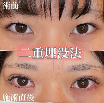 双眼皮手术