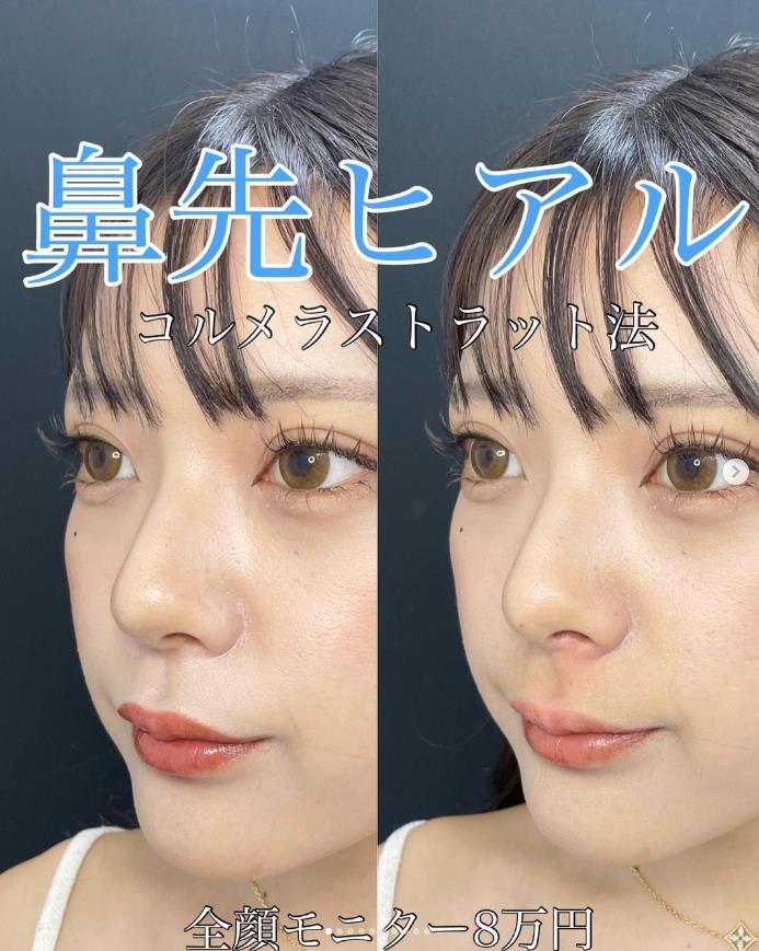 玻尿酸填充
