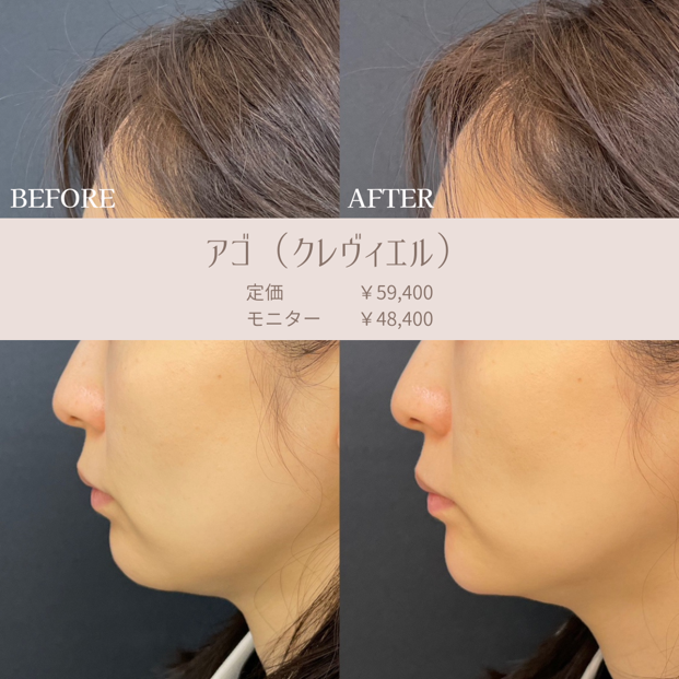 玻尿酸填充
