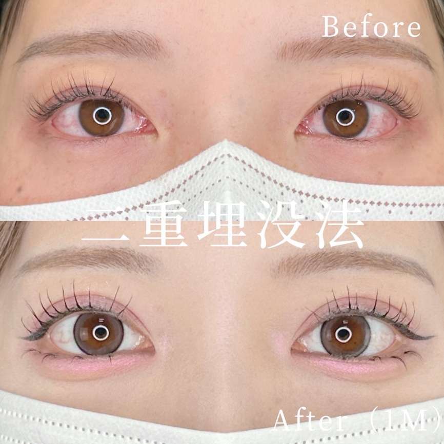 双眼皮手术