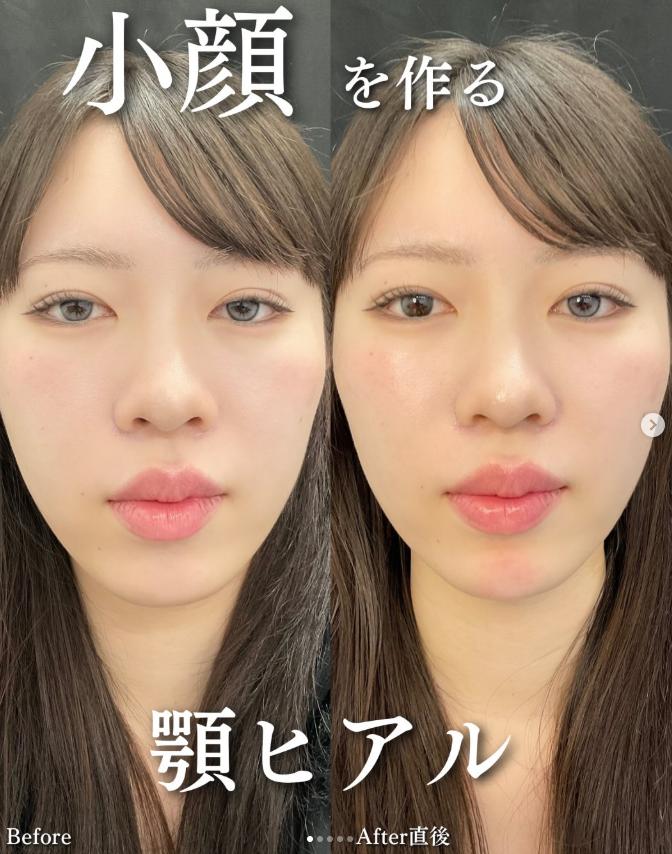玻尿酸填充