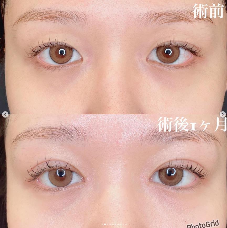 双眼皮手术