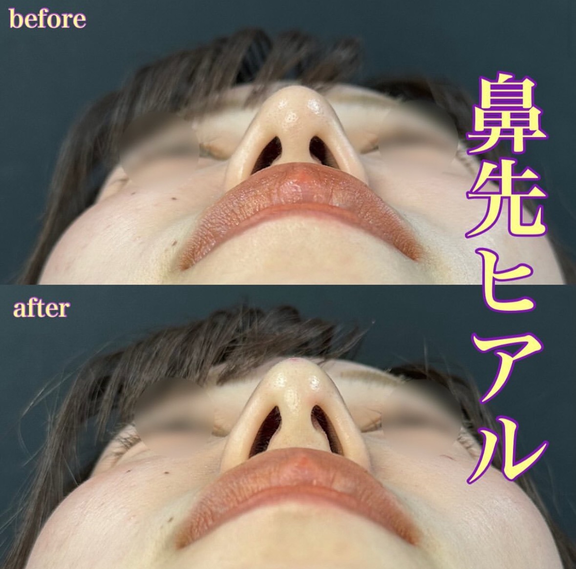玻尿酸填充