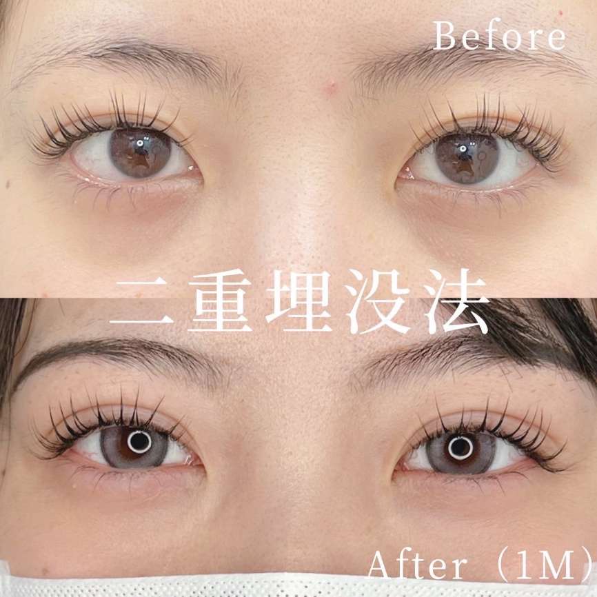 双眼皮手术