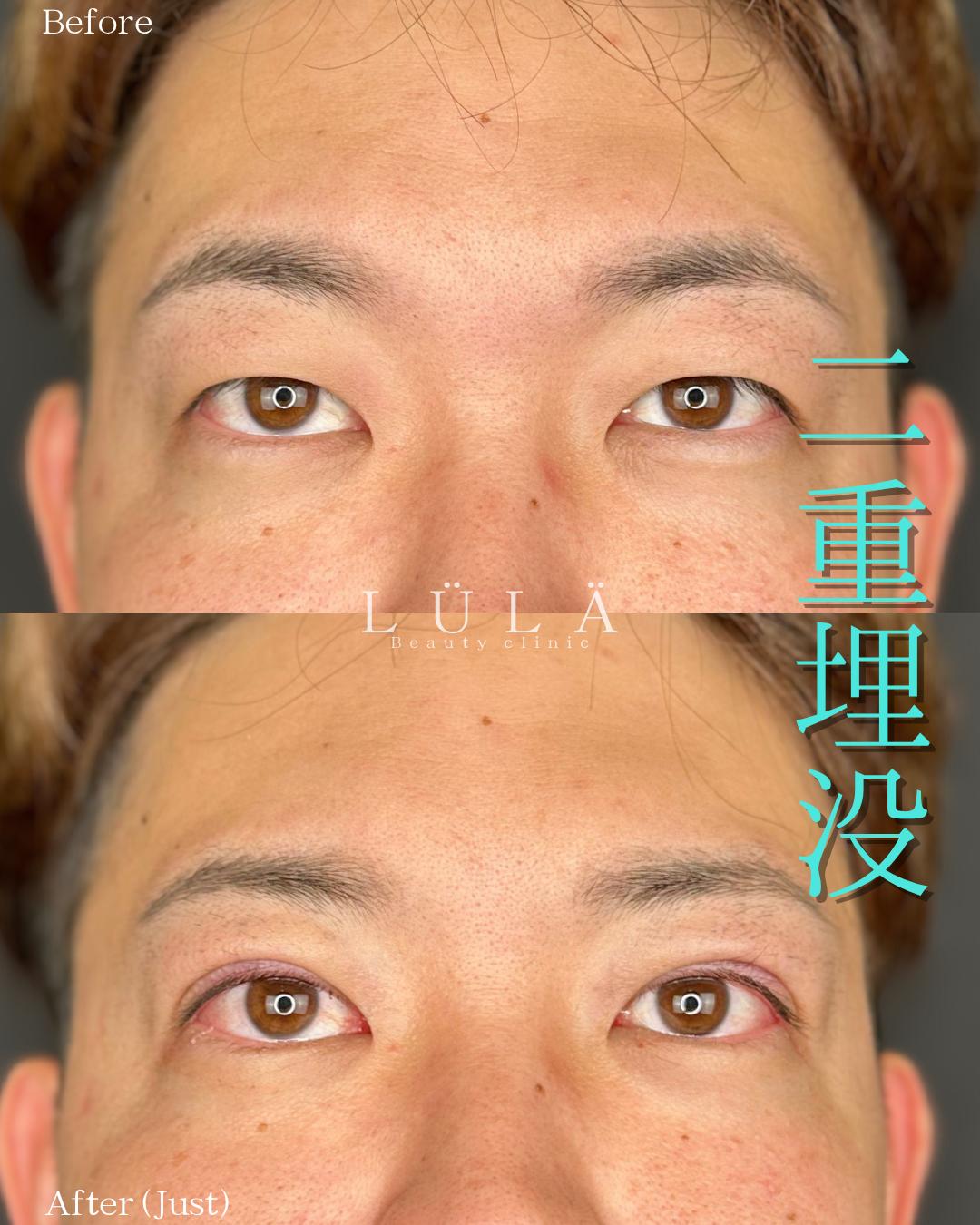 双眼皮手术