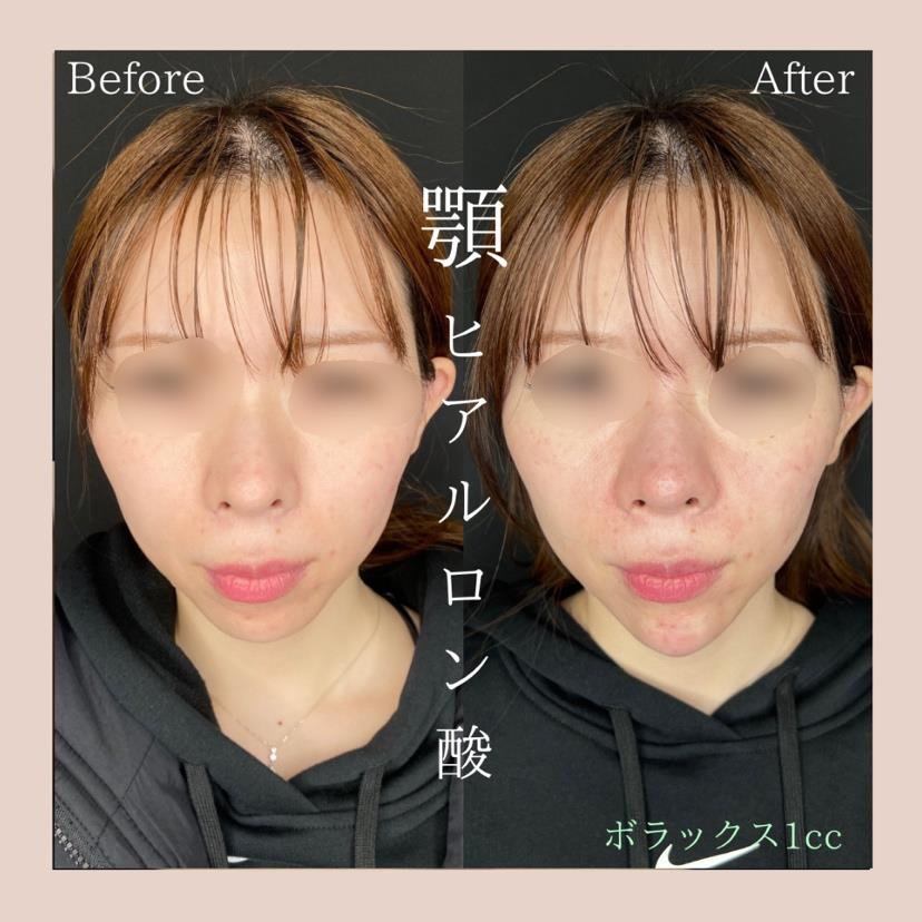 玻尿酸填充