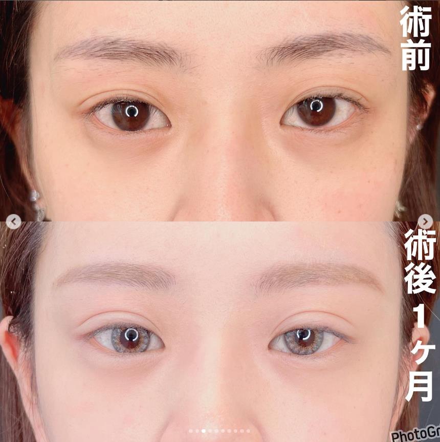 双眼皮手术