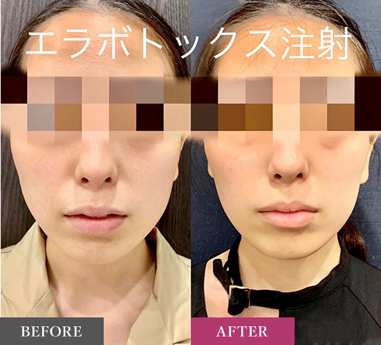 咬肌瘦脸针