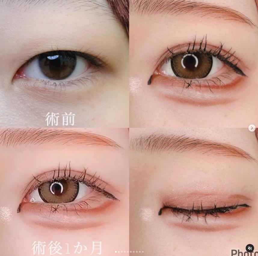 双眼皮手术