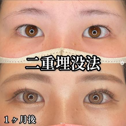 双眼皮手术